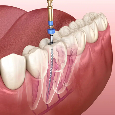 Advanced Root Canal Techniques with Apex Locator